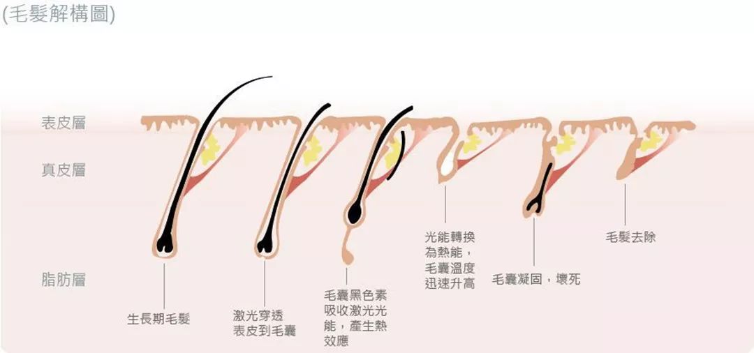 “白煮蛋”與“獼猴桃”之間，還差一個它 強脈沖脫毛器械，值得買嗎？